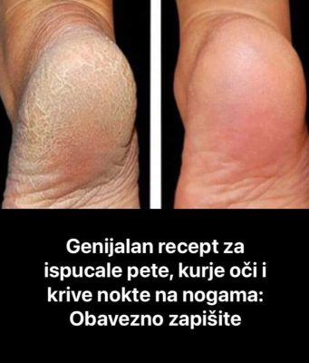 GENIJALAN RECEPT ZA GRUBE RUKE, ISPUCALE PETE, KURJE OČI I KRIVE NOKTE NA NOGAMA: