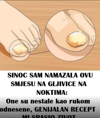 Sinoć sam ovom mješavinom uspješno izliječila gljivice na noktima i na moje iznenađenje nestale su kao nekom čarolijom.