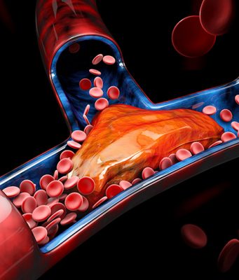 PLUĆNA EMBOLIJA JE VEĆI UZROK SMRTI OD INFARKTA! Dr Seferović otkriva: “Glavni simptom se vidi na nozi”