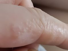 Das sind diese kleinen juckenden Beulen an deinen Fingern