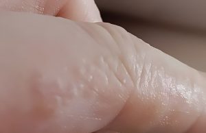 Das sind diese kleinen juckenden Beulen an deinen Fingern
