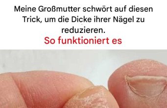 Der Trick zur Reduzierung der Zehennageldicke