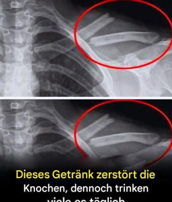 Dieses Getränk zerstört die Knochen, dennoch trinken viele Menschen es täglich
