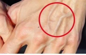 Wenn Sie sichtbare Venen haben, bedeutet das, dass Sie